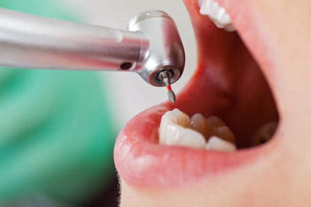 Best Emergency Wisdom Teeth Removal in Hernando Beach, FL